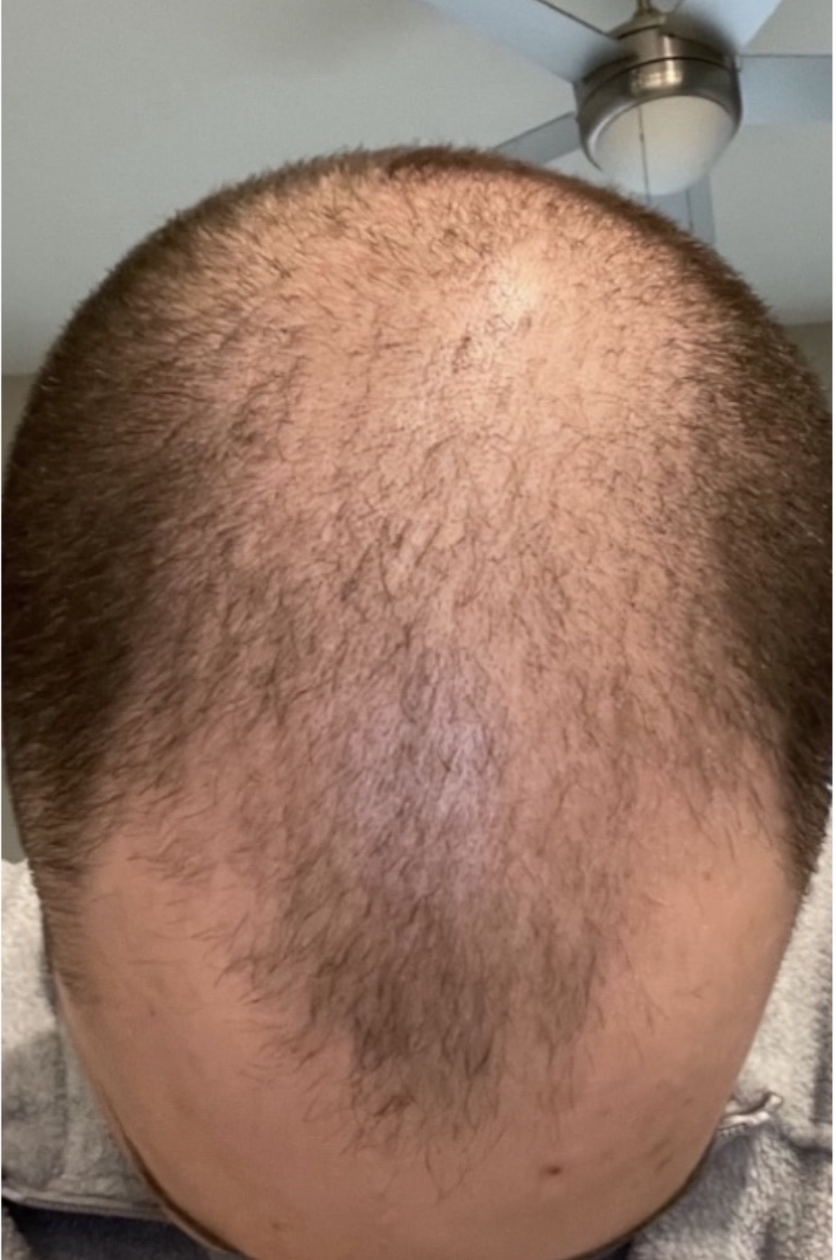 Before — visible crown thinning